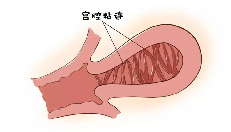 宫腔粘连有什么症状