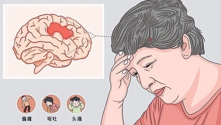 什么是卒中