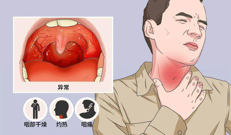 急性咽炎有什么症状