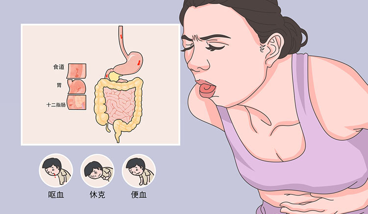 上消化道出血有什么症状