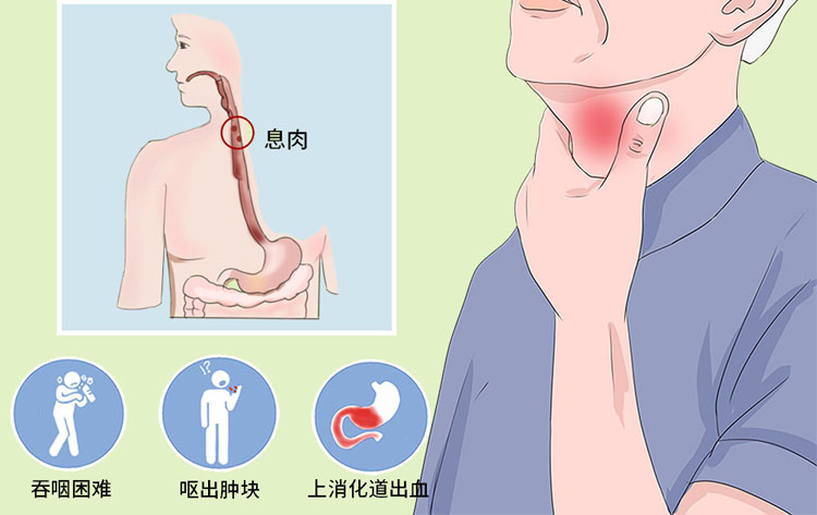 食管息肉有什么症状