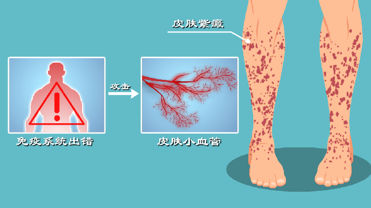 过敏性紫癜的危害有哪些