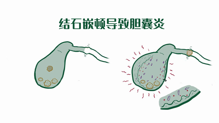 结石性胆囊炎有哪些临床症状