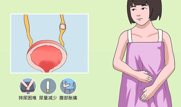 尿路梗阻有哪些症状